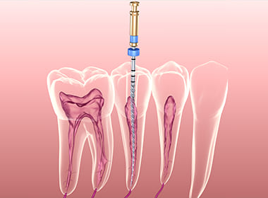 重度の虫歯・根管治療にも対応