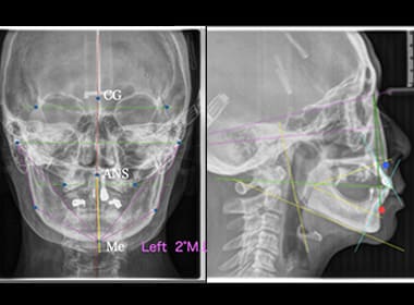セファロ分析（顔貌レントゲン）