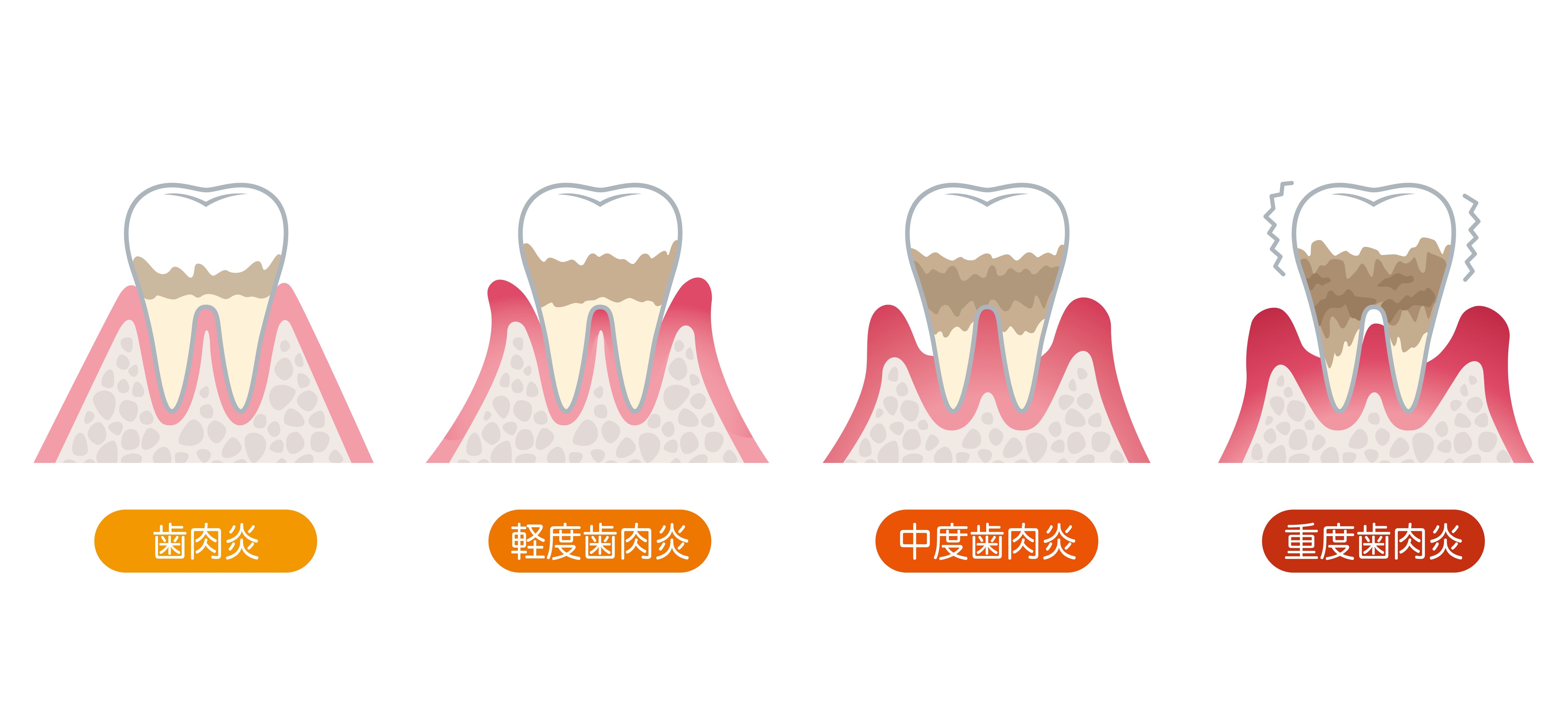 痛みがなくても進行している歯周病