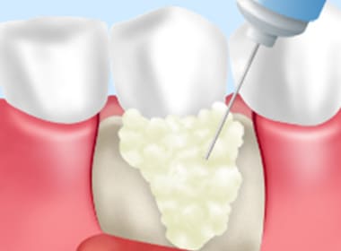 歯周組織の再生療法に対応
