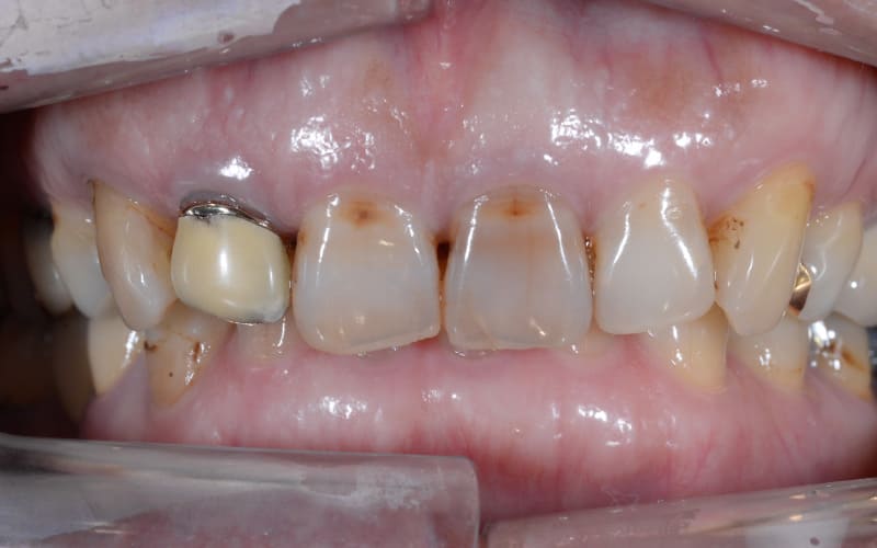 前歯セラミック治療