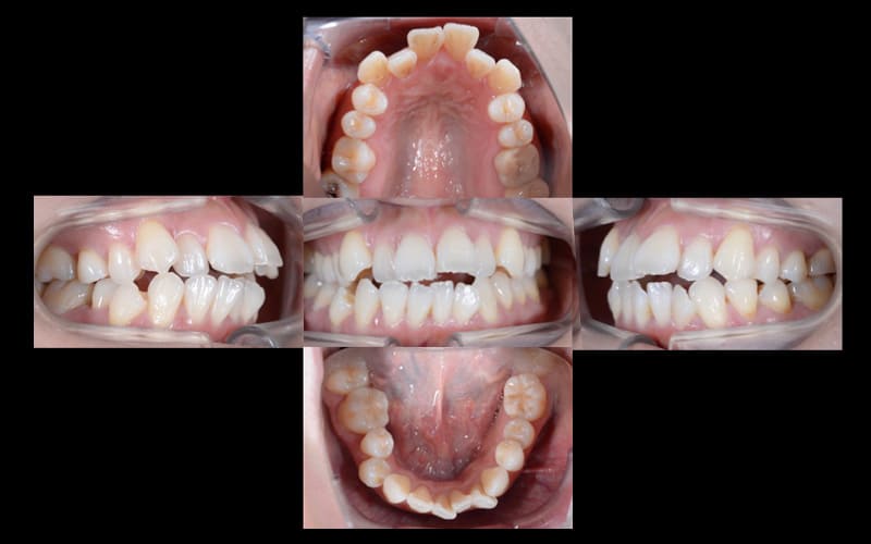 非抜歯矯正症例