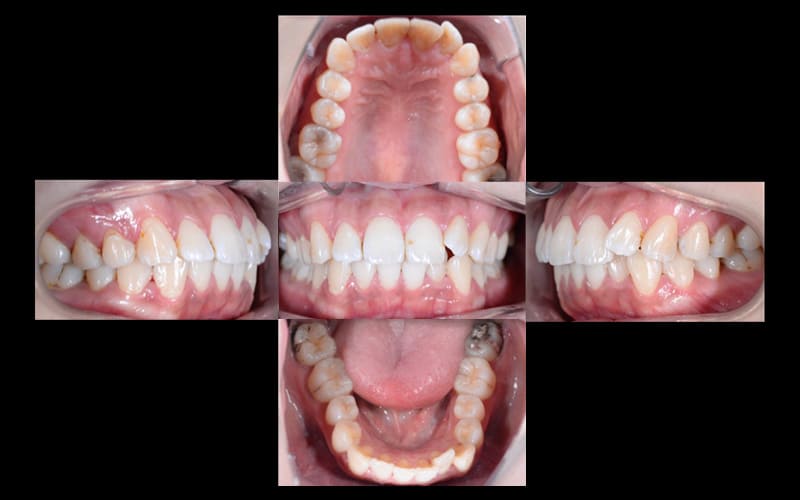 小臼歯抜歯矯正症例